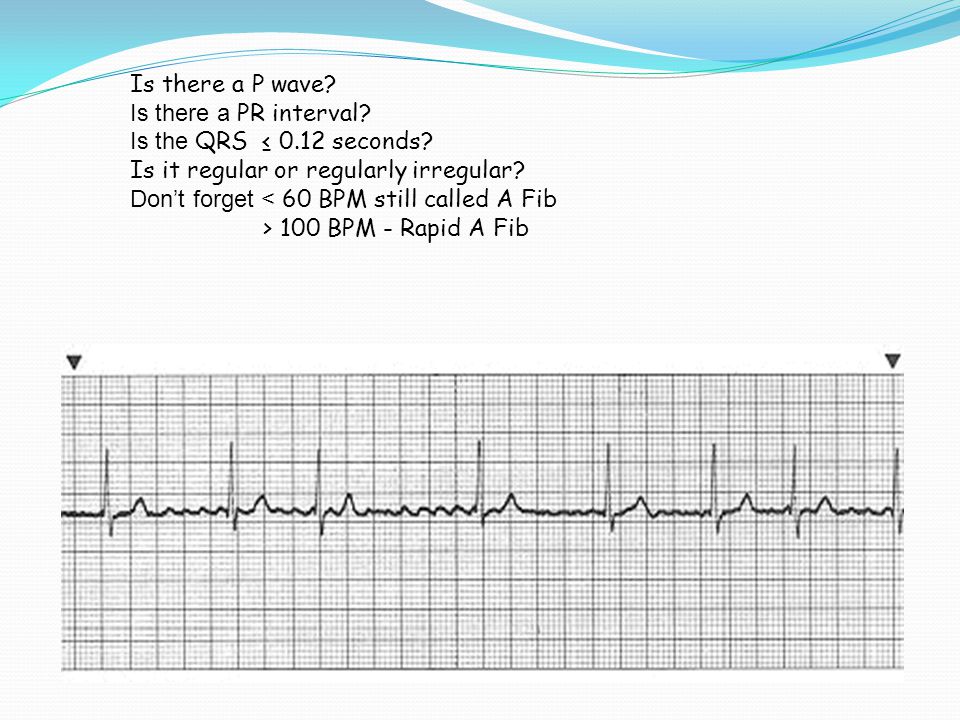 Is there a P wave. Is there a PR interval. Is the QRS ≤ seconds
