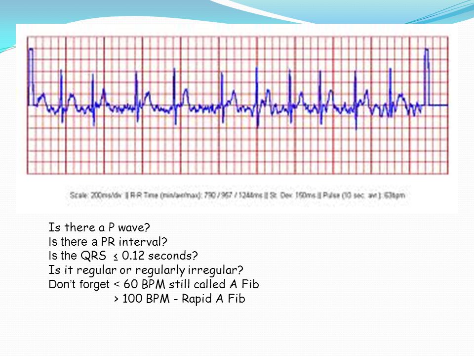 Is there a P wave. Is there a PR interval. Is the QRS ≤ seconds