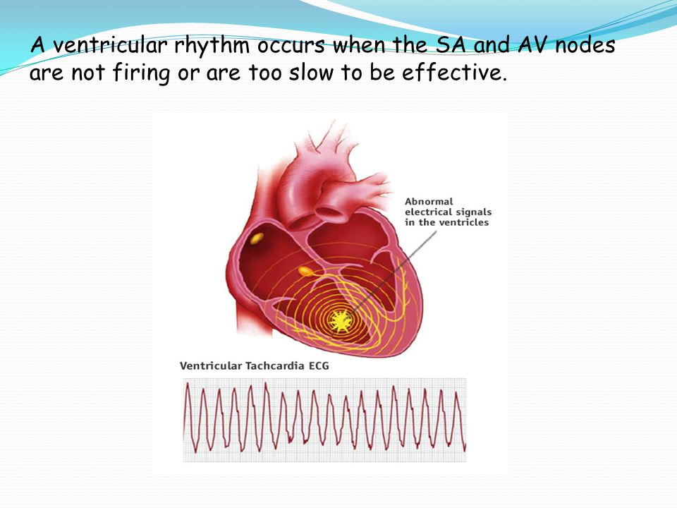 A ventricular rhythm occurs when the SA and AV nodes are not firing or are too slow to be effective.