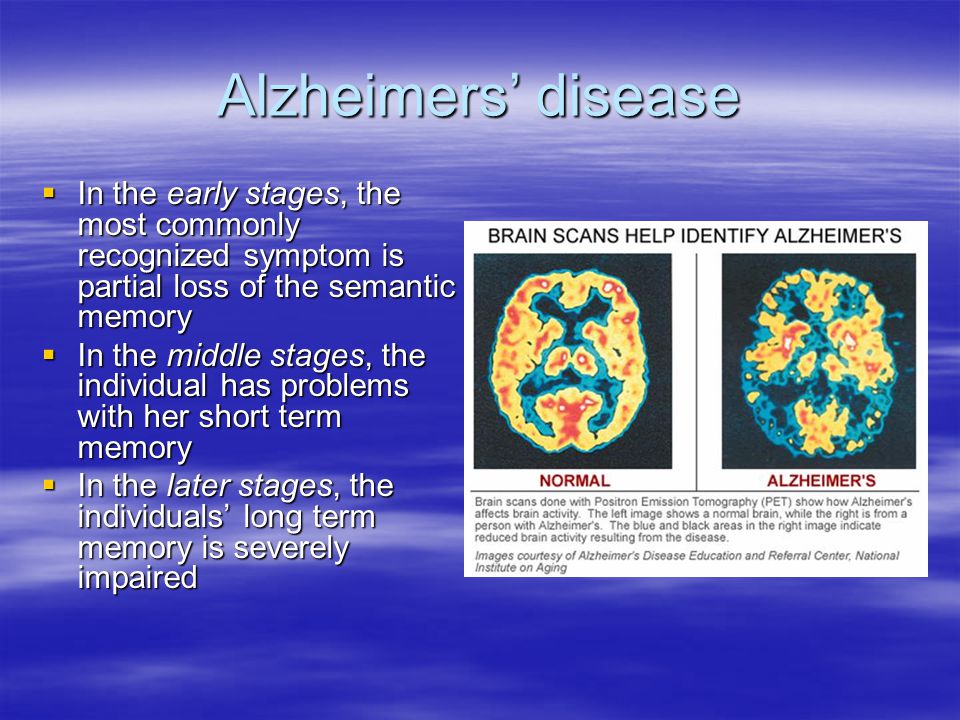 Alzheimers’ disease In the early stages, the most commonly recognized symptom is partial loss of the semantic memory.