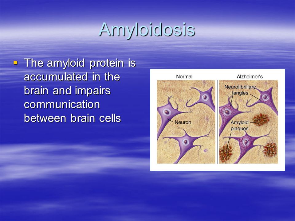 Amyloidosis The amyloid protein is accumulated in the brain and impairs communication between brain cells.