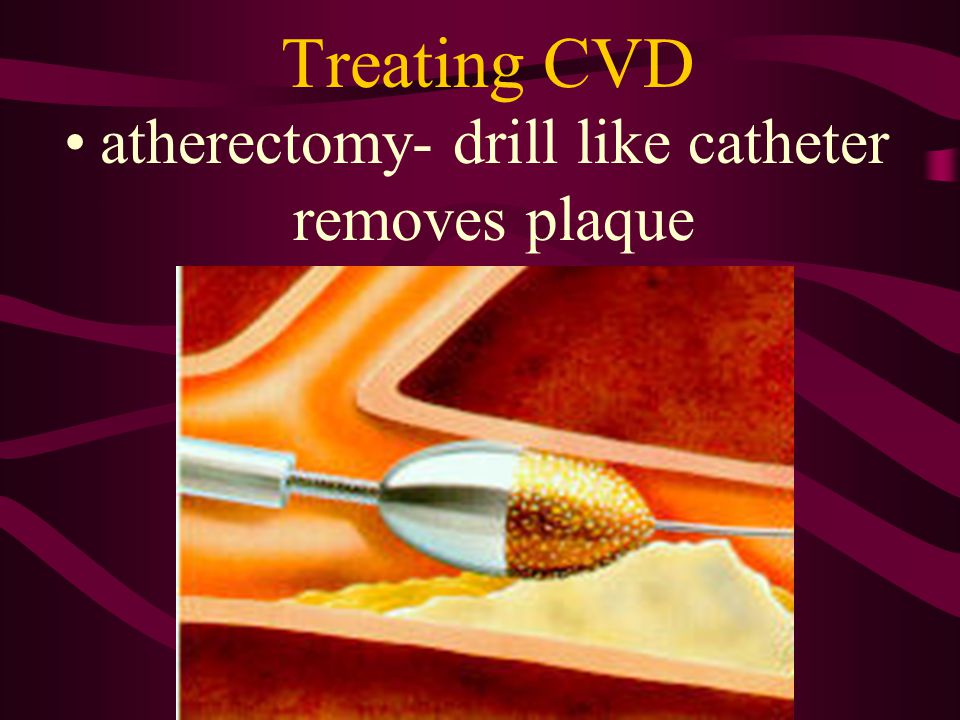 atherectomy- drill like catheter removes plaque