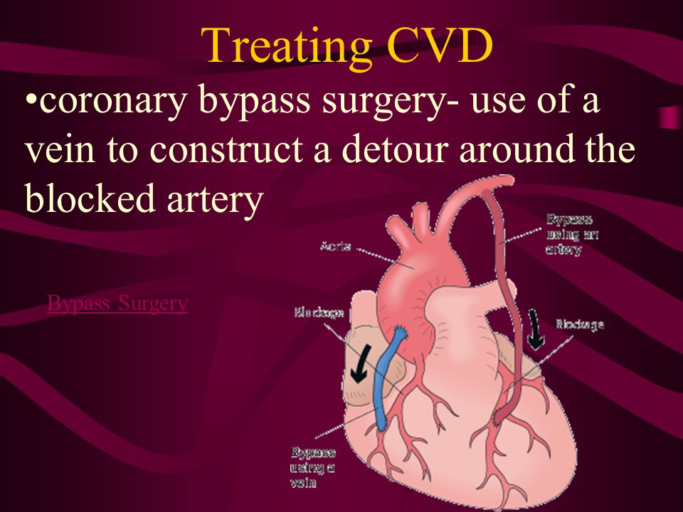 Treating CVD coronary bypass surgery- use of a vein to construct a detour around the blocked artery.