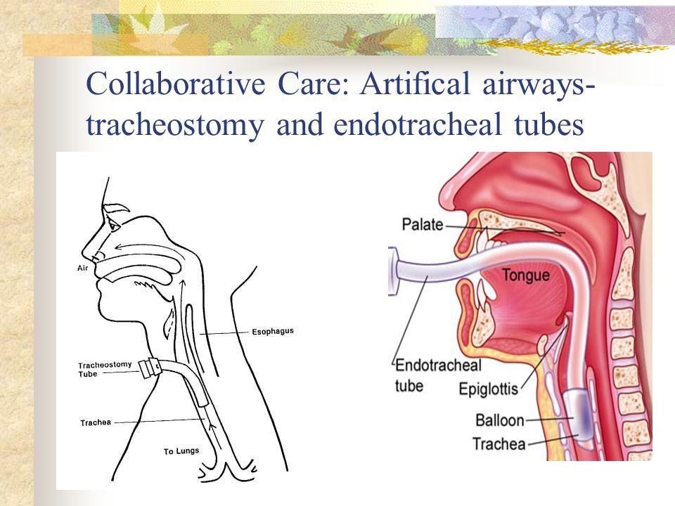 Collaborative Care: Artifical airways- tracheostomy and endotracheal tubes