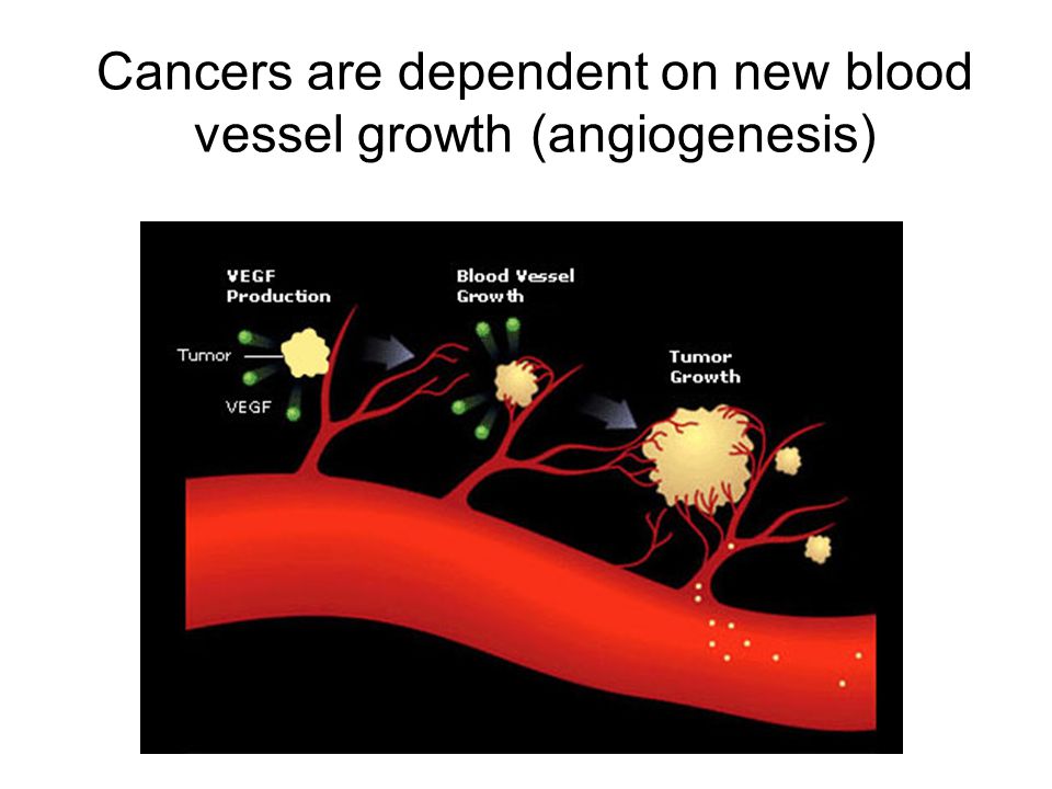 Cancers are dependent on new blood vessel growth (angiogenesis)