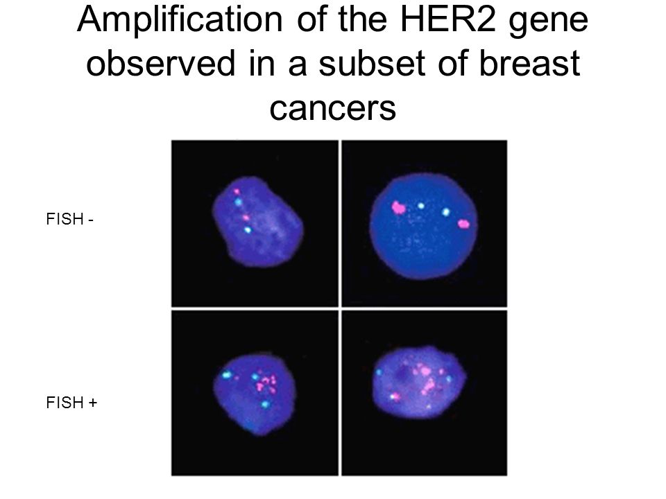 Amplification of the HER2 gene observed in a subset of breast cancers