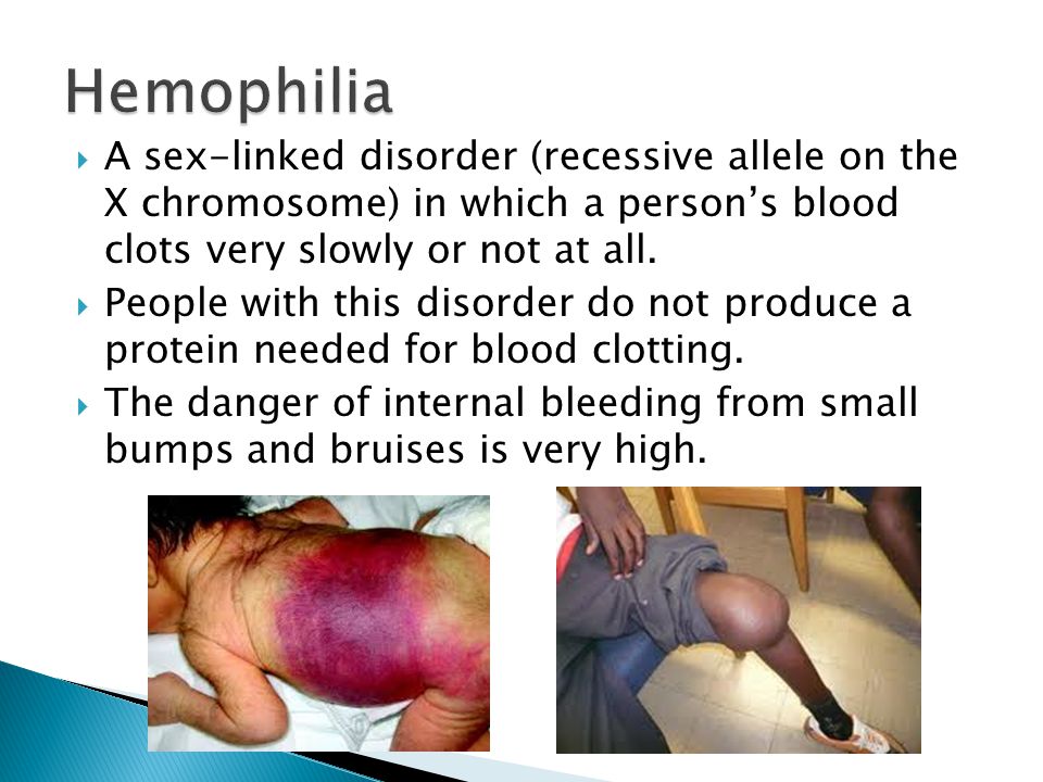 Hemophilia A sex-linked disorder (recessive allele on the X chromosome) in which a person’s blood clots very slowly or not at all.