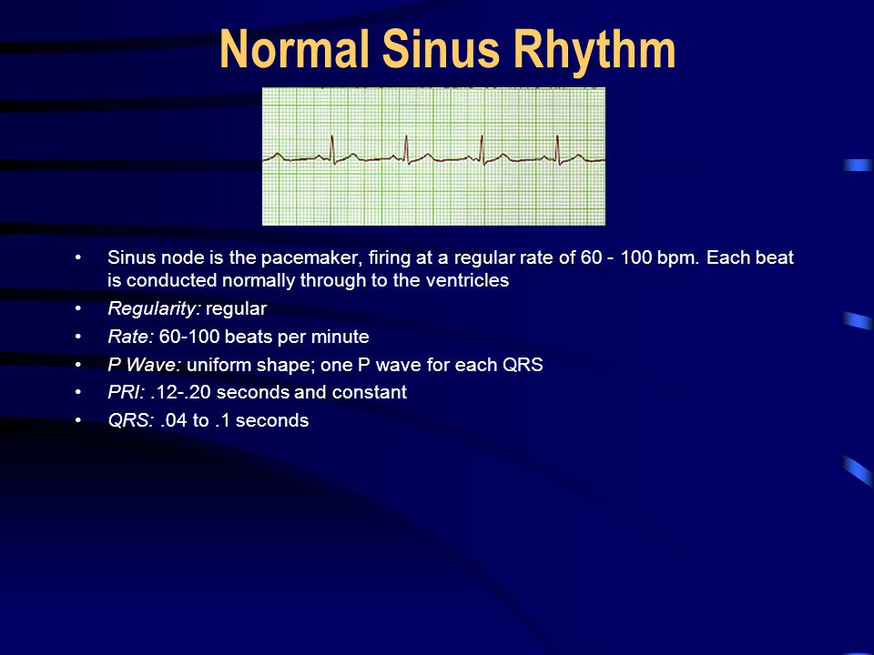 Normal Sinus Rhythm Sinus node is the pacemaker, firing at a regular rate of bpm. Each beat is conducted normally through to the ventricles.