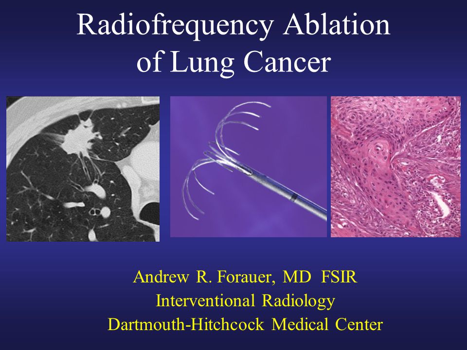 Radiofrequency Ablation of Lung Cancer