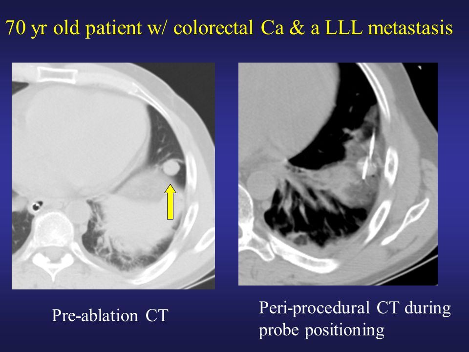 70 yr old patient w/ colorectal Ca & a LLL metastasis