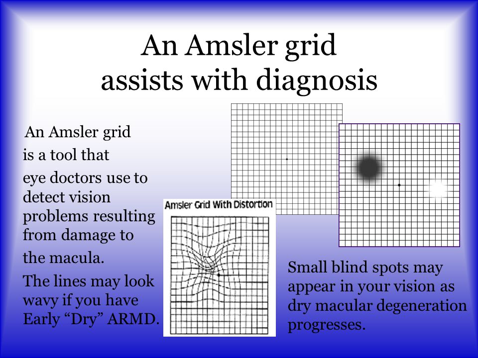 An Amsler grid assists with diagnosis