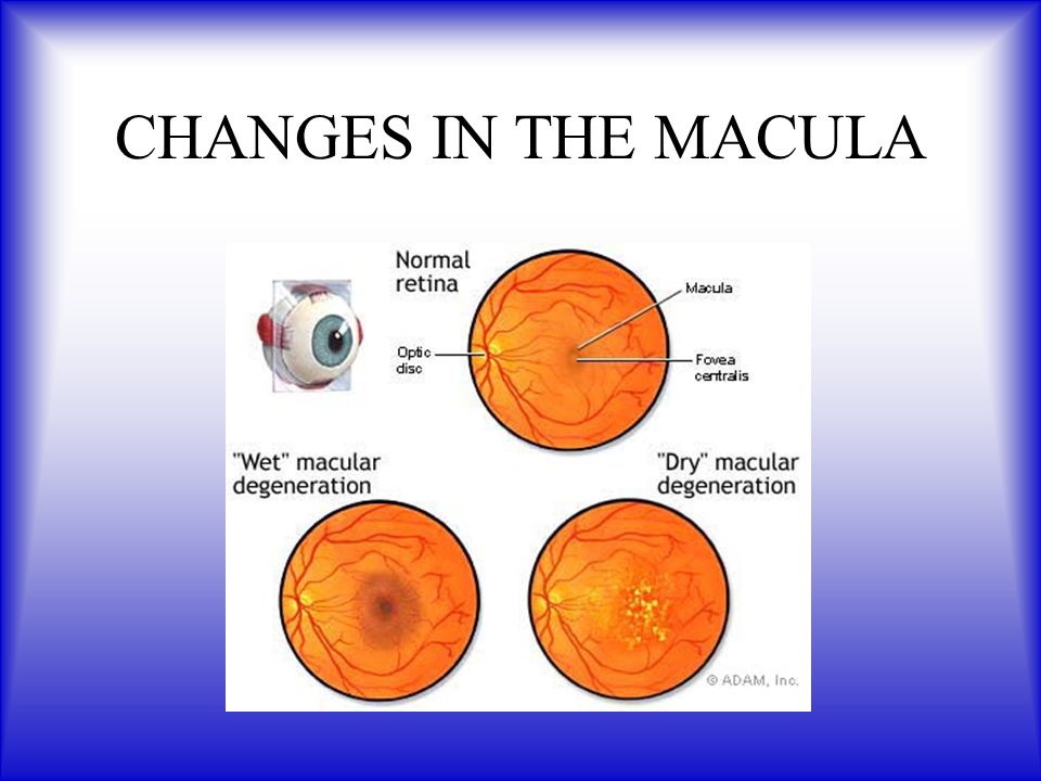 CHANGES IN THE MACULA