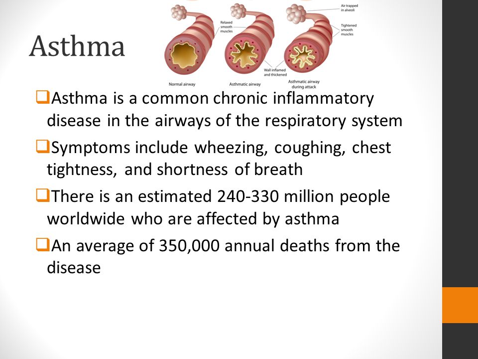 Asthma Asthma is a common chronic inflammatory disease in the airways of the respiratory system.