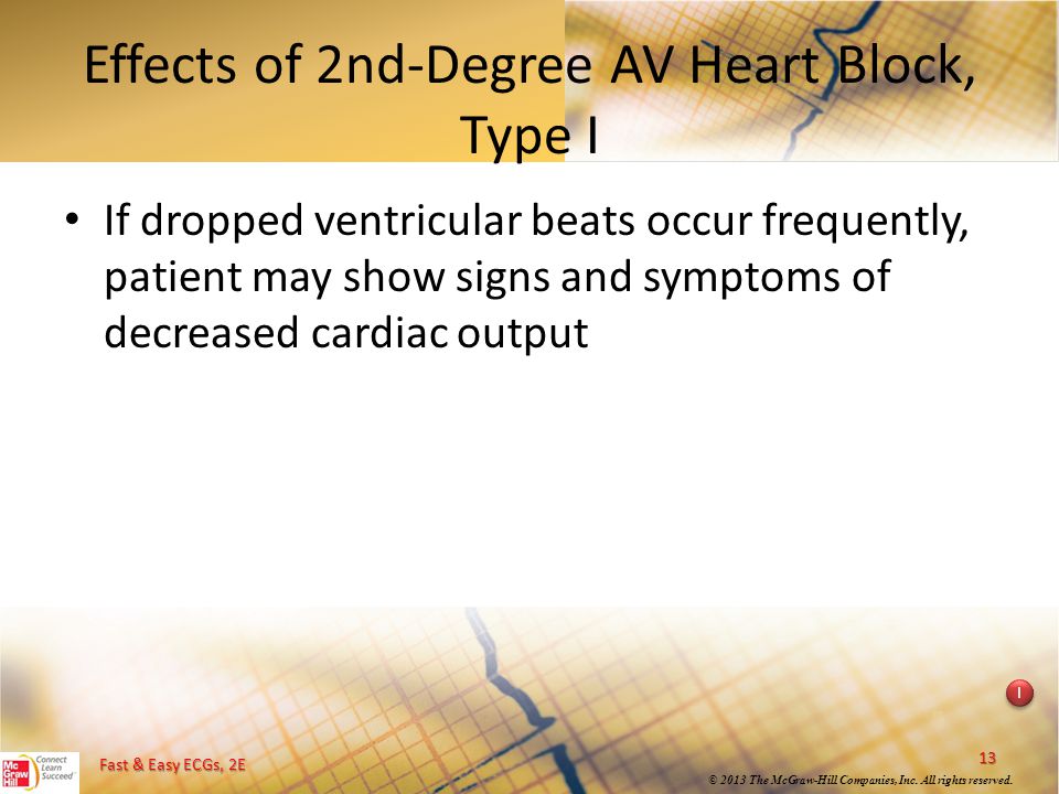 Effects of 2nd-Degree AV Heart Block, Type I