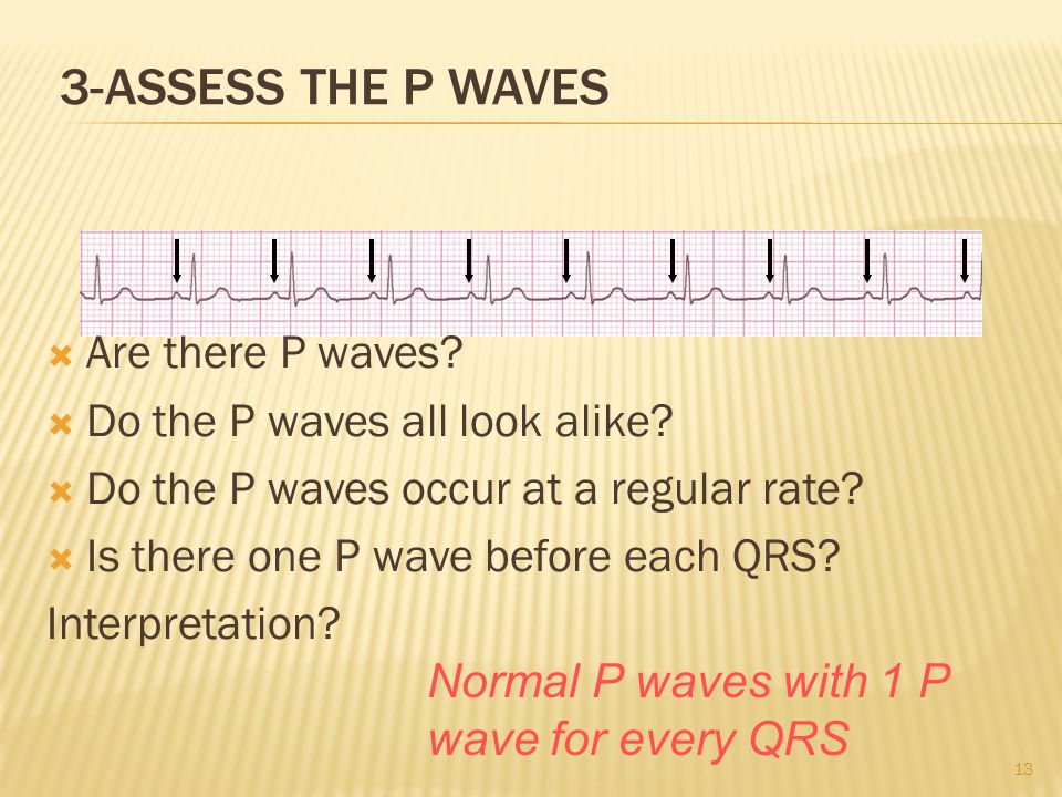 3-Assess the P waves Are there P waves Do the P waves all look alike