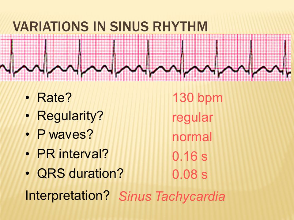 Variations in Sinus Rhythm