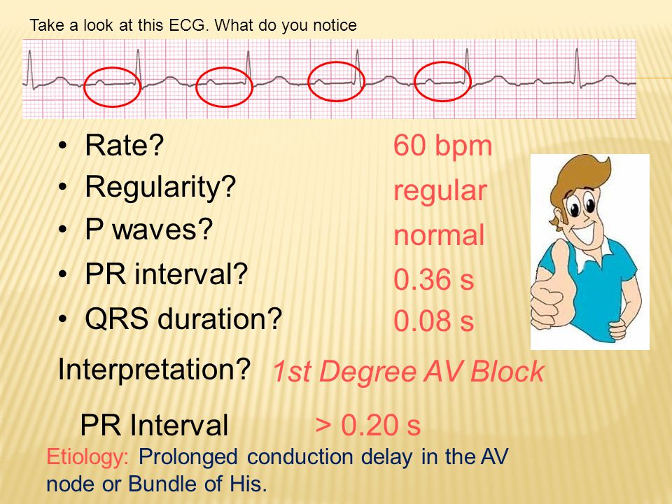 Rate 60 bpm Regularity regular P waves normal PR interval 0.36 s