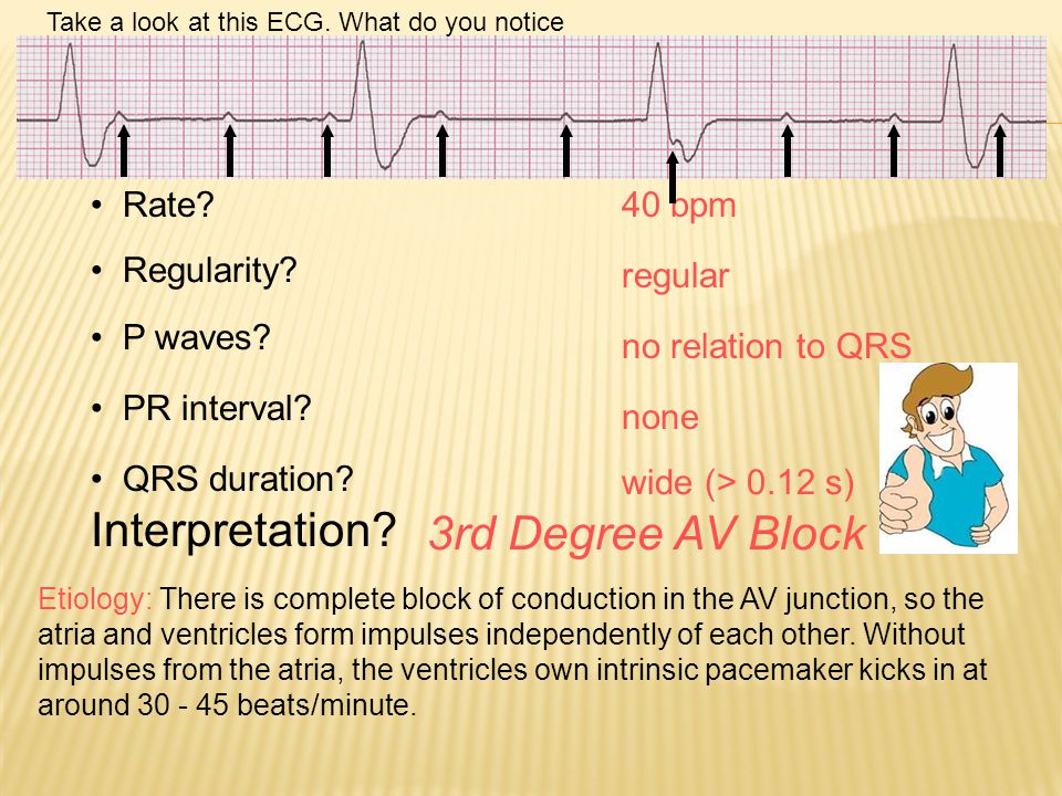 Interpretation 3rd Degree AV Block Rate 40 bpm Regularity regular