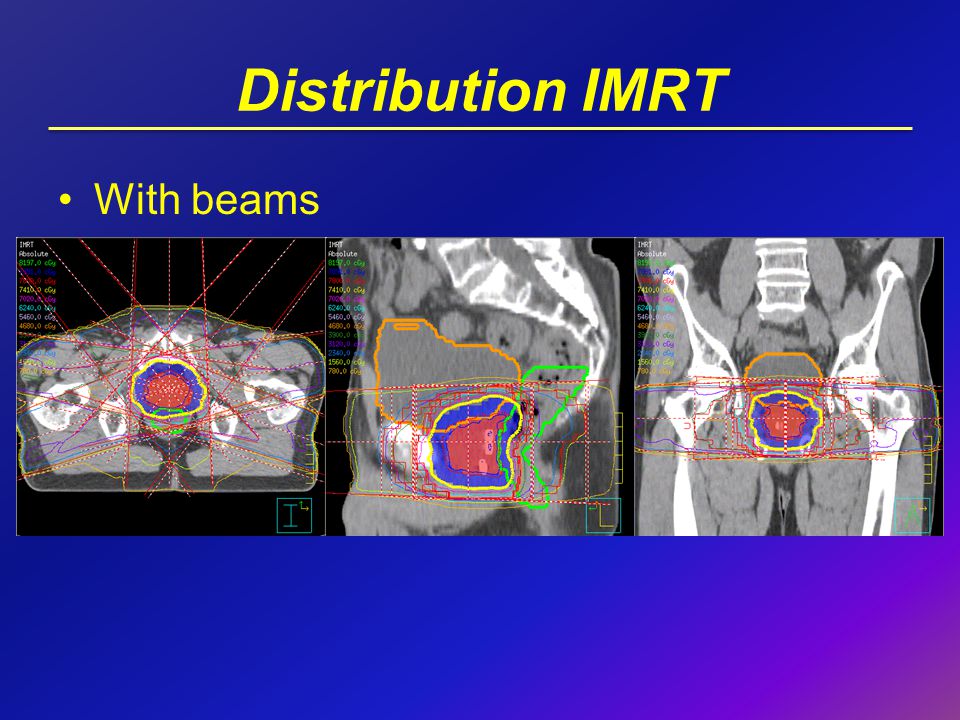 Distribution IMRT With beams