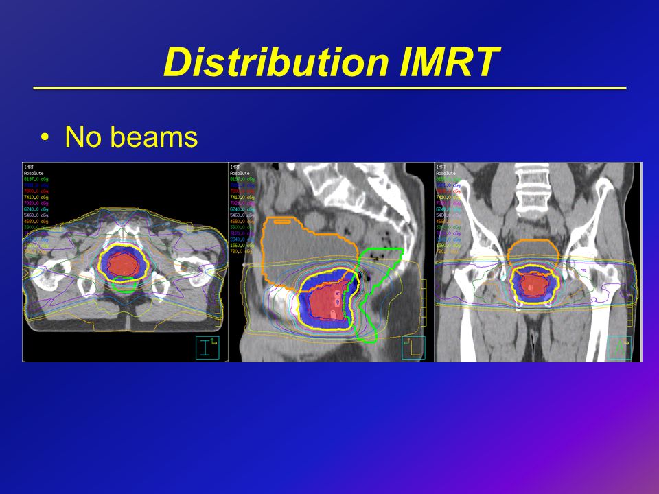 Distribution IMRT No beams