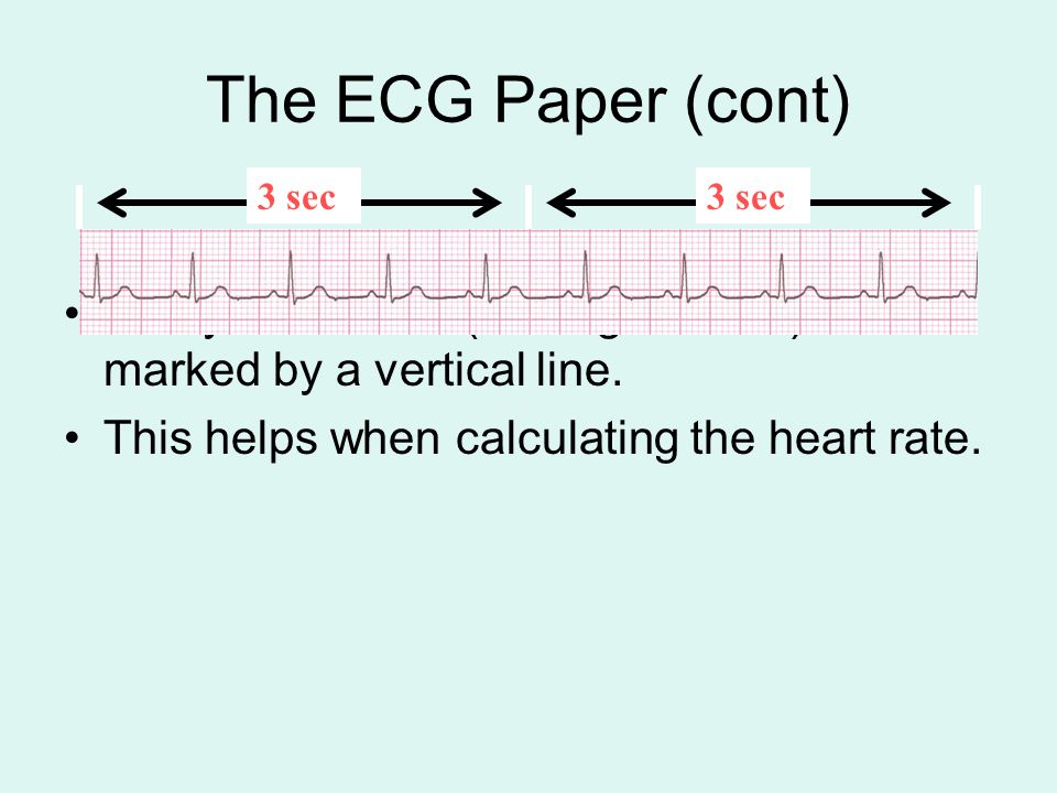 The ECG Paper (cont) 3 sec. 3 sec. Every 3 seconds (15 large boxes) is marked by a vertical line.