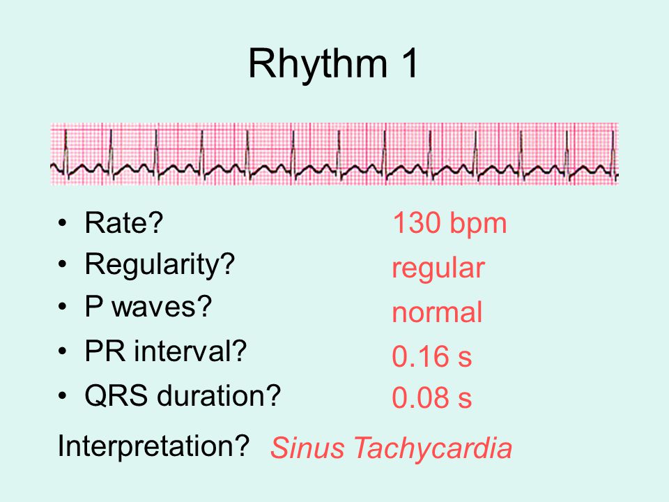 Rhythm 1 Rate 130 bpm Regularity regular P waves normal