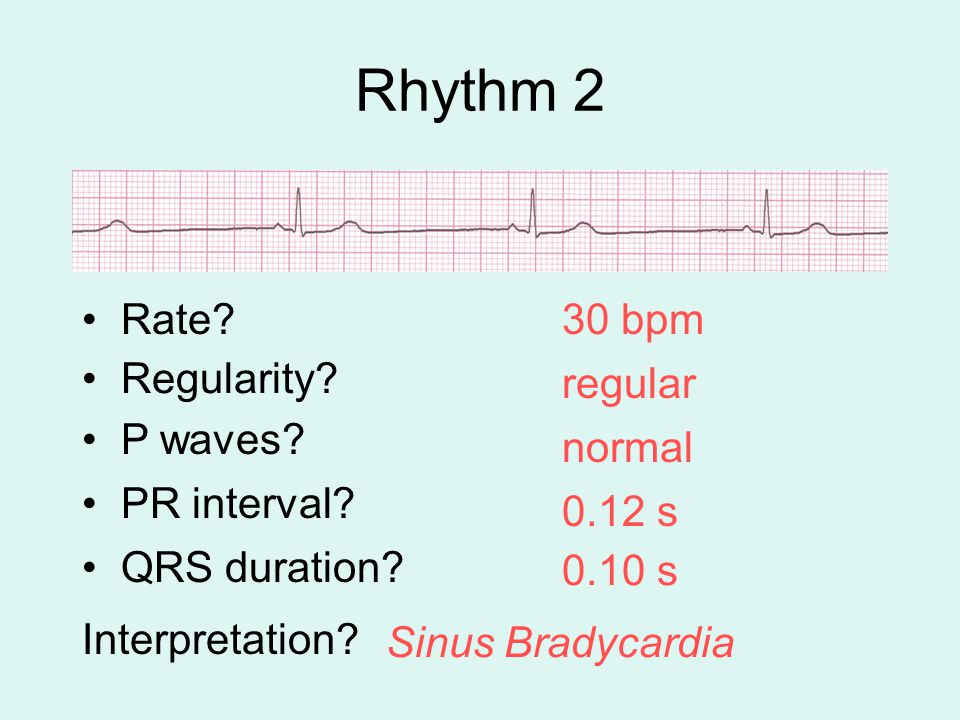 Rhythm 2 Rate 30 bpm Regularity regular P waves normal PR interval