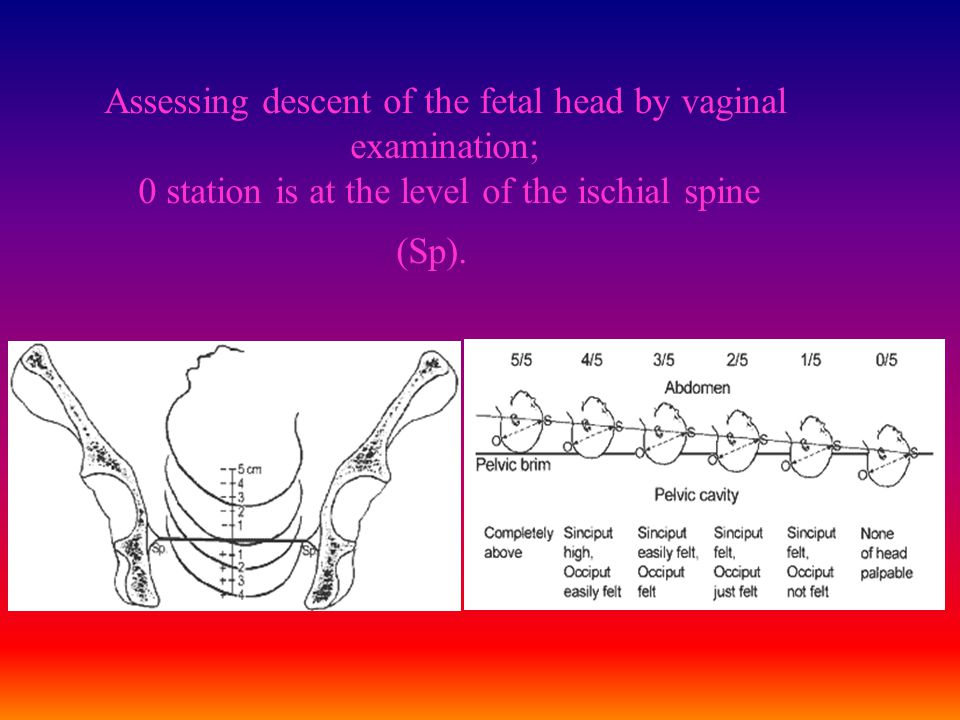 Assessing descent of the fetal head by vaginal examination; 0 station is at the level of the ischial spine (Sp).