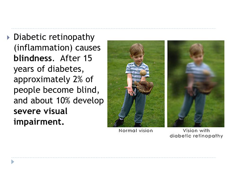 Diabetic retinopathy (inflammation) causes blindness