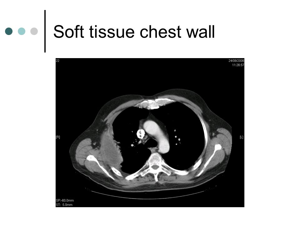 Soft tissue chest wall