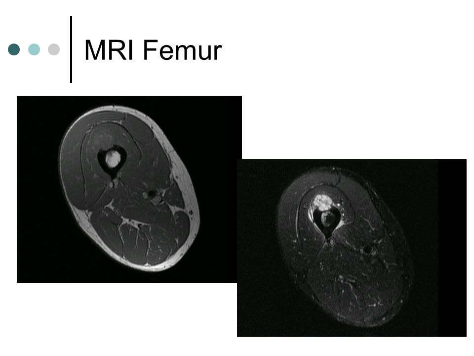 MRI Femur