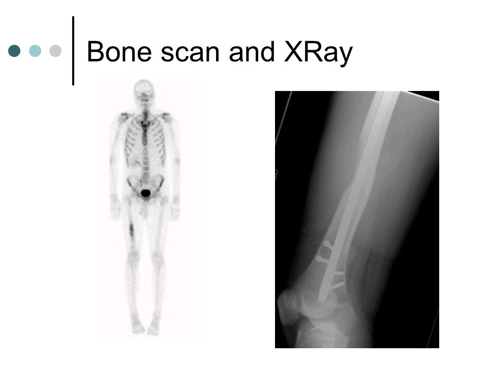 Bone scan and XRay