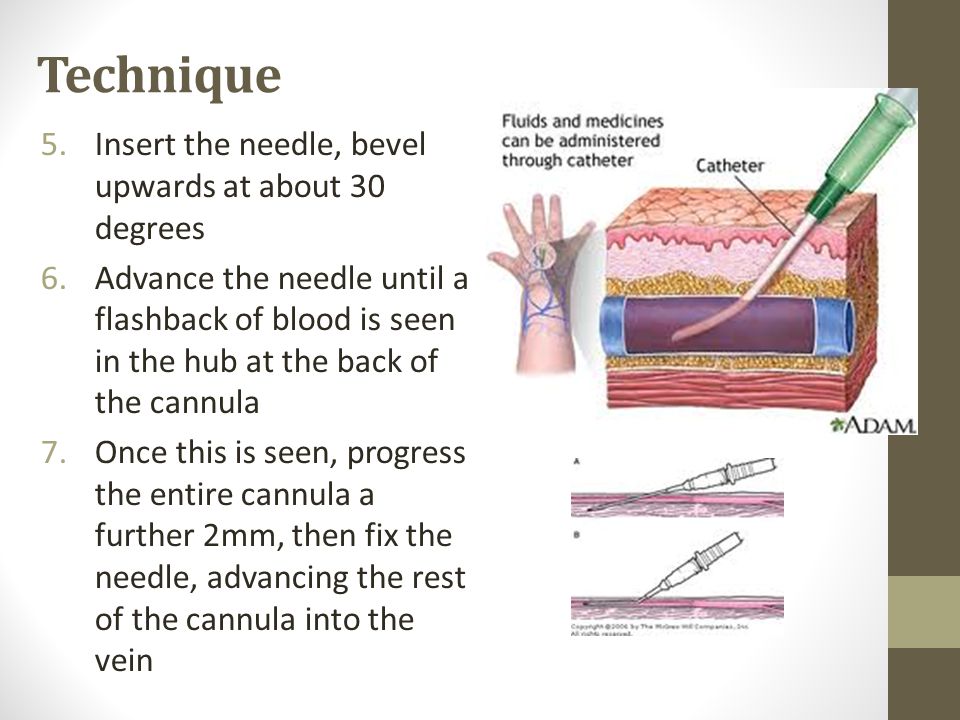 Technique Insert the needle, bevel upwards at about 30 degrees