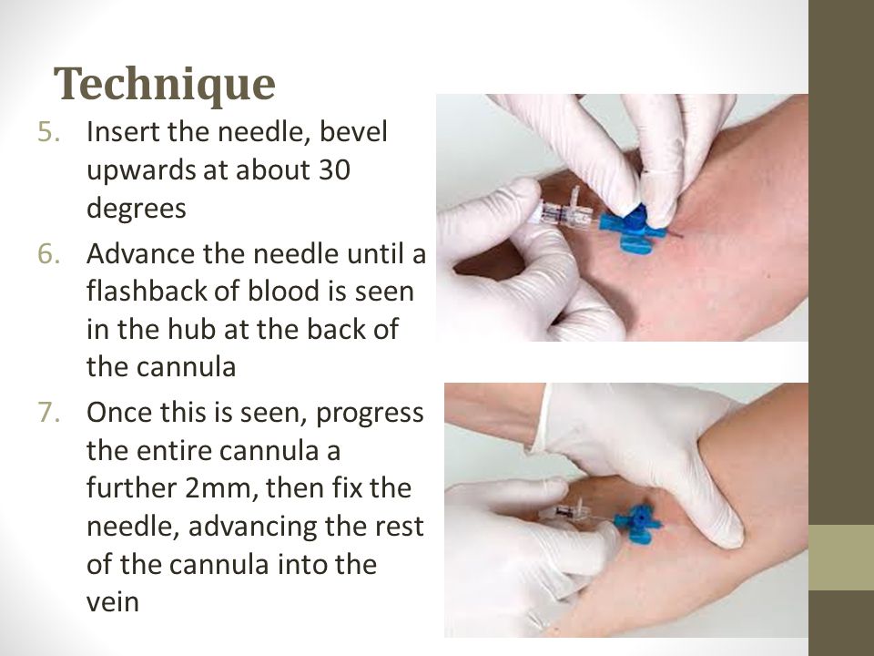 Technique Insert the needle, bevel upwards at about 30 degrees