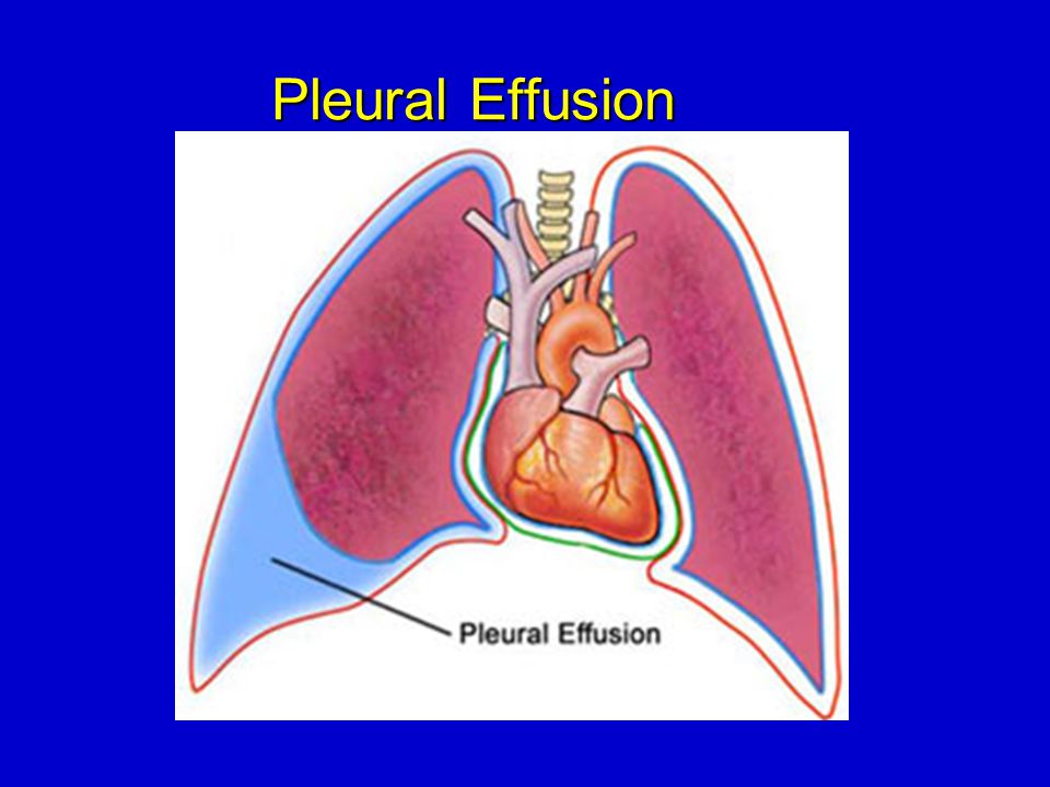 pleural effusion, pneumothorax and atelectasis