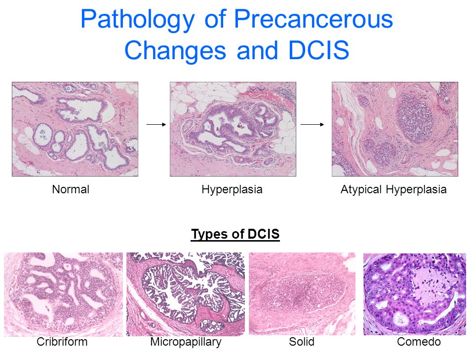 Pathology of Precancerous Changes and DCIS
