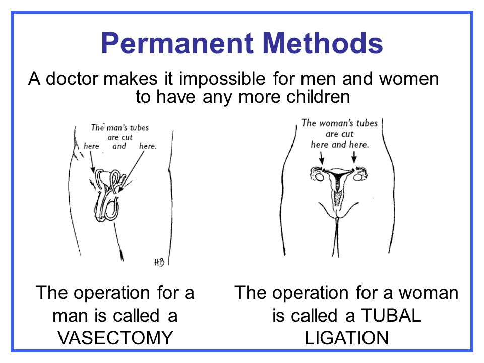 Permanent Methods A doctor makes it impossible for men and women to have any more children. The operation for a man is called a VASECTOMY.