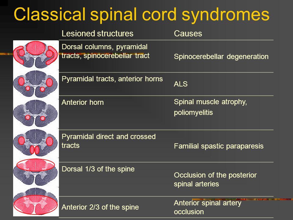 Classical spinal cord syndromes