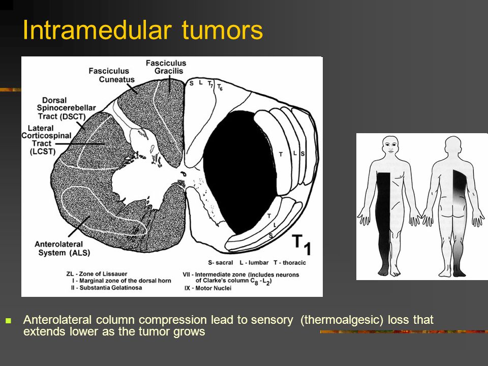 Intramedular tumors Anterolateral column compression lead to sensory (thermoalgesic) loss that extends lower as the tumor grows.
