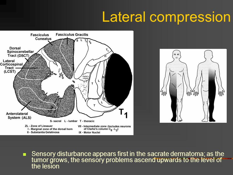 Lateral compression