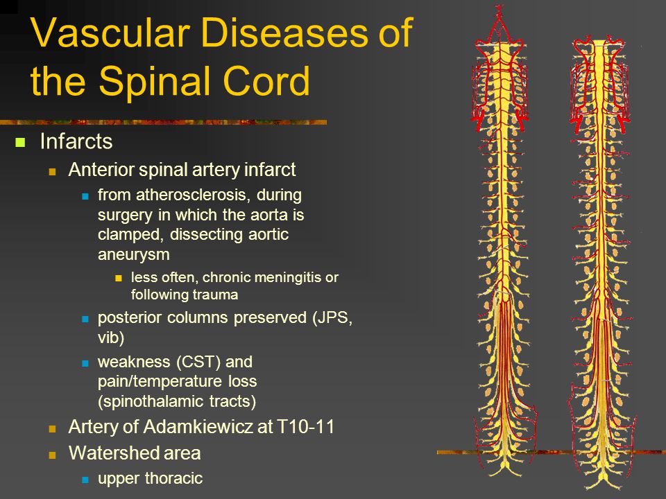 Vascular Diseases of the Spinal Cord