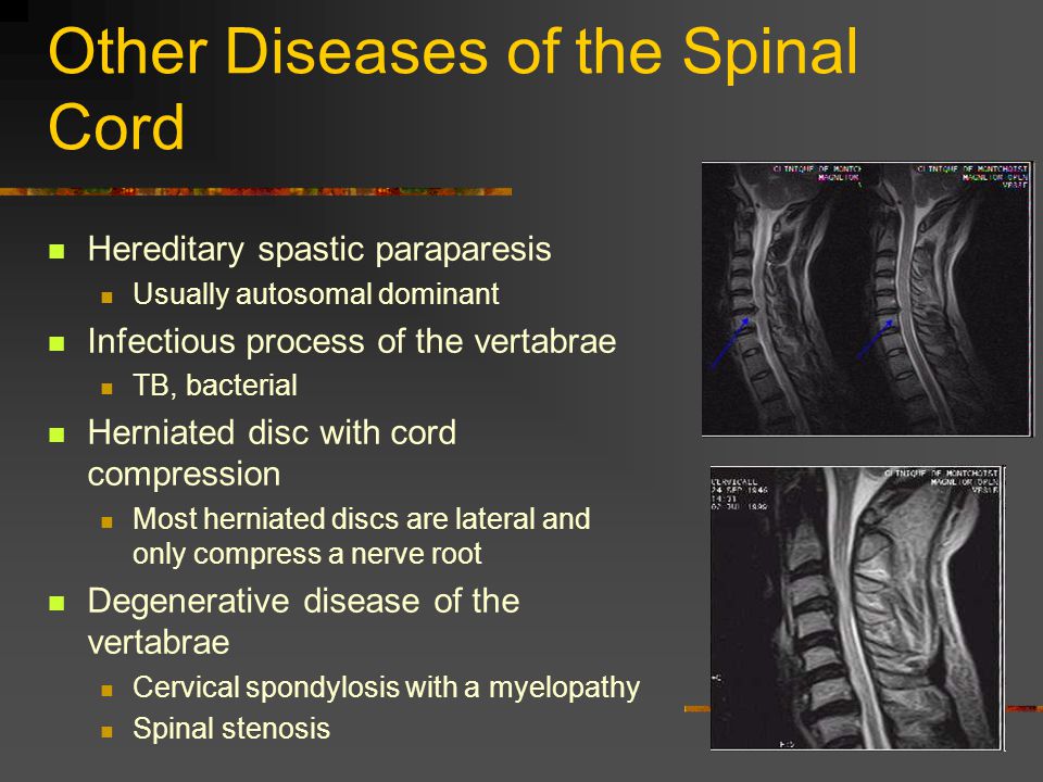 Other Diseases of the Spinal Cord