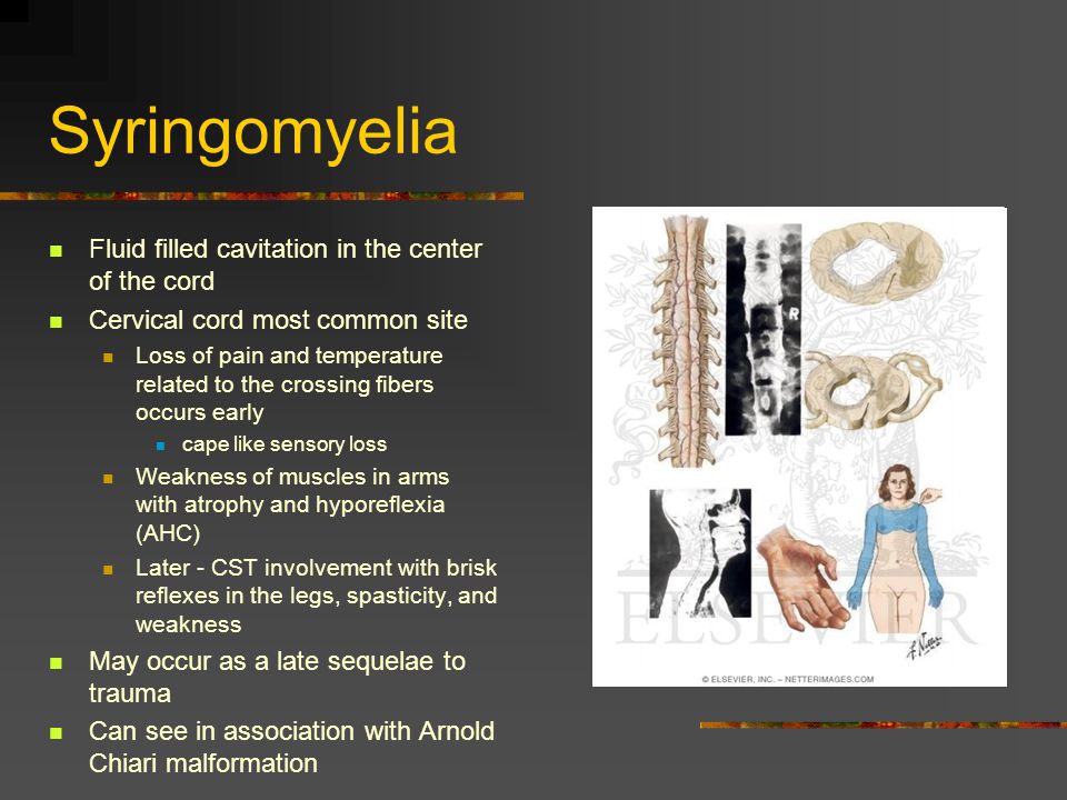 Syringomyelia Fluid filled cavitation in the center of the cord