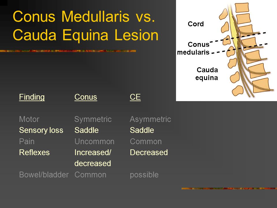 Conus Medullaris vs. Cauda Equina Lesion