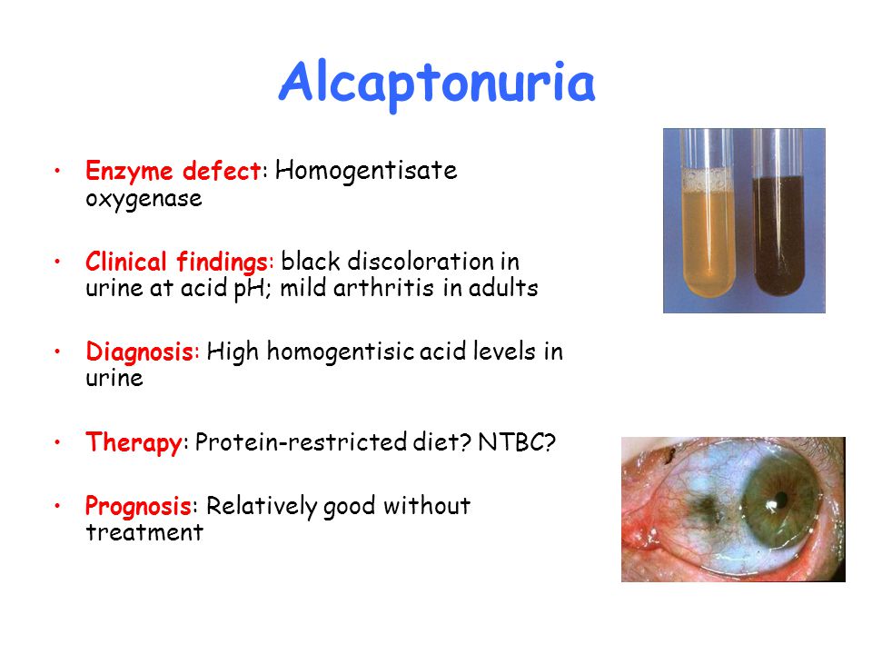 Alcaptonuria Enzyme defect: Homogentisate oxygenase