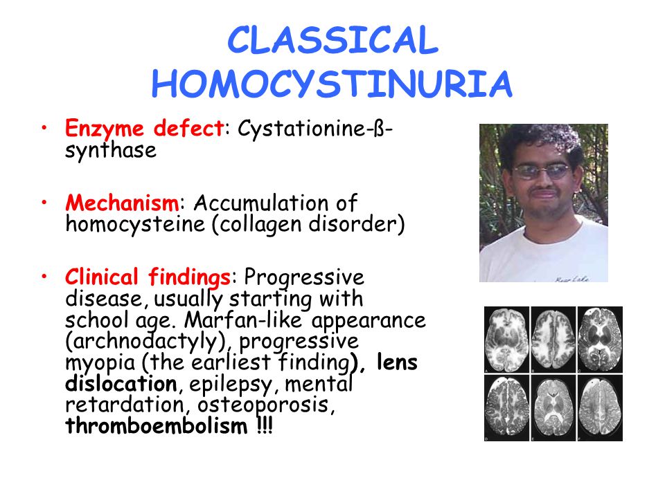 CLASSICAL HOMOCYSTINURIA