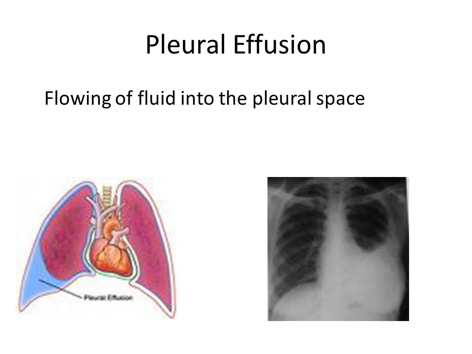 Pleural Effusion Flowing of fluid into the pleural space