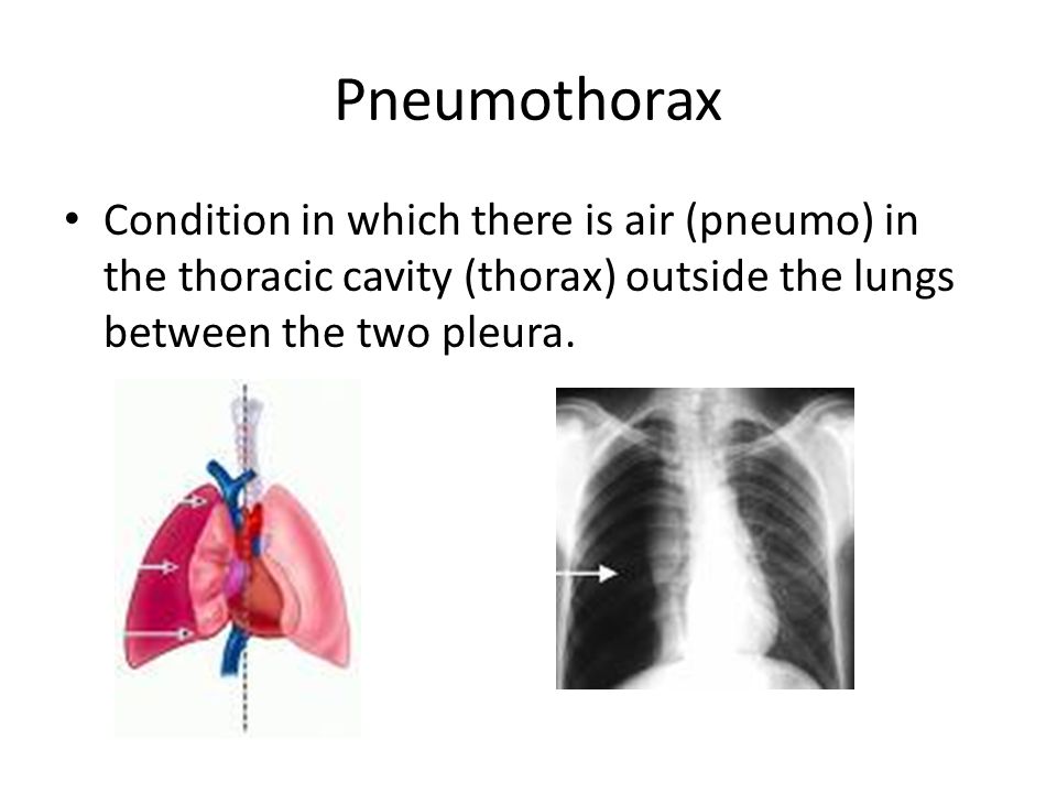 Pneumothorax Condition in which there is air (pneumo) in the thoracic cavity (thorax) outside the lungs between the two pleura.