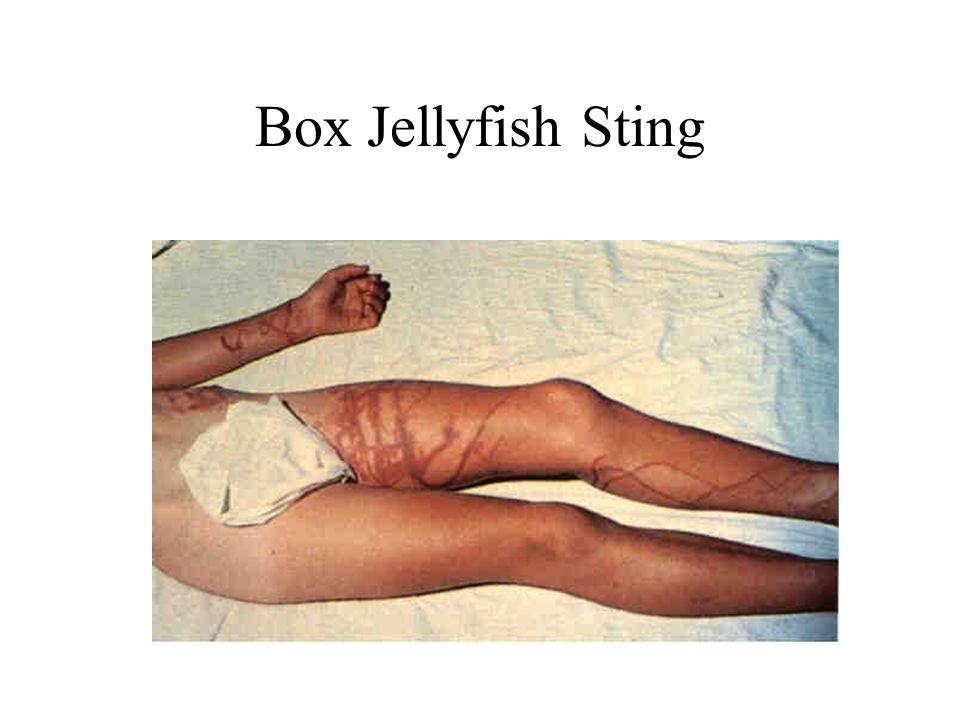Box Jellyfish Sting