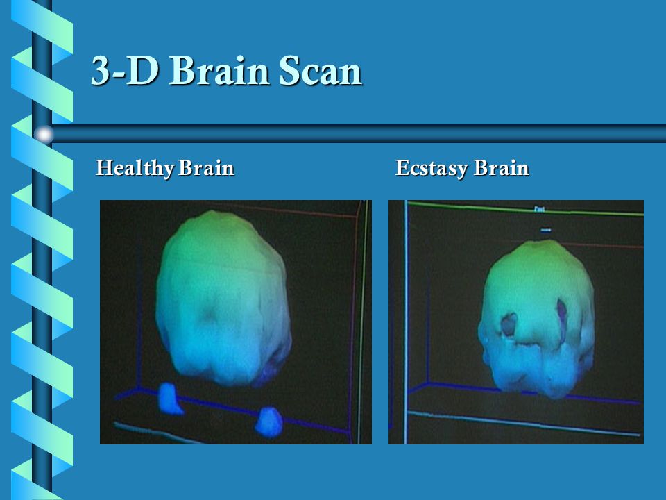 3-D Brain Scan Healthy Brain Ecstasy Brain